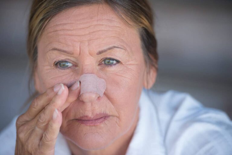 Nasal-Fractures